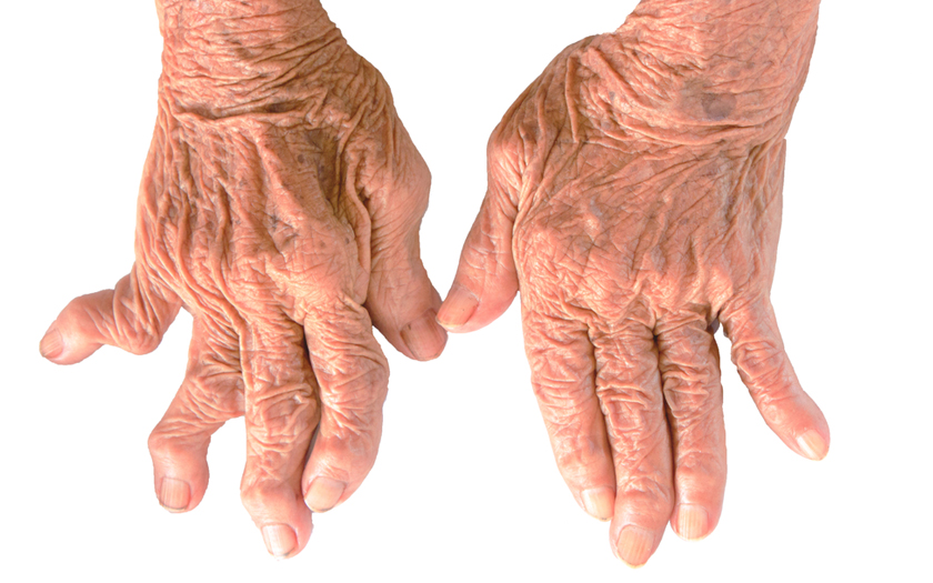 Why Is Rheumatoid Arthritis More Common in Women