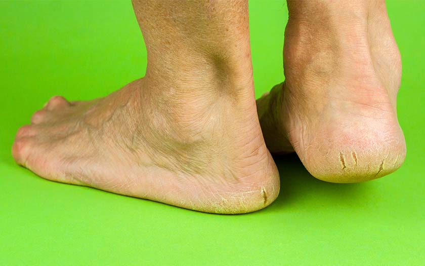 tips for cracked heels